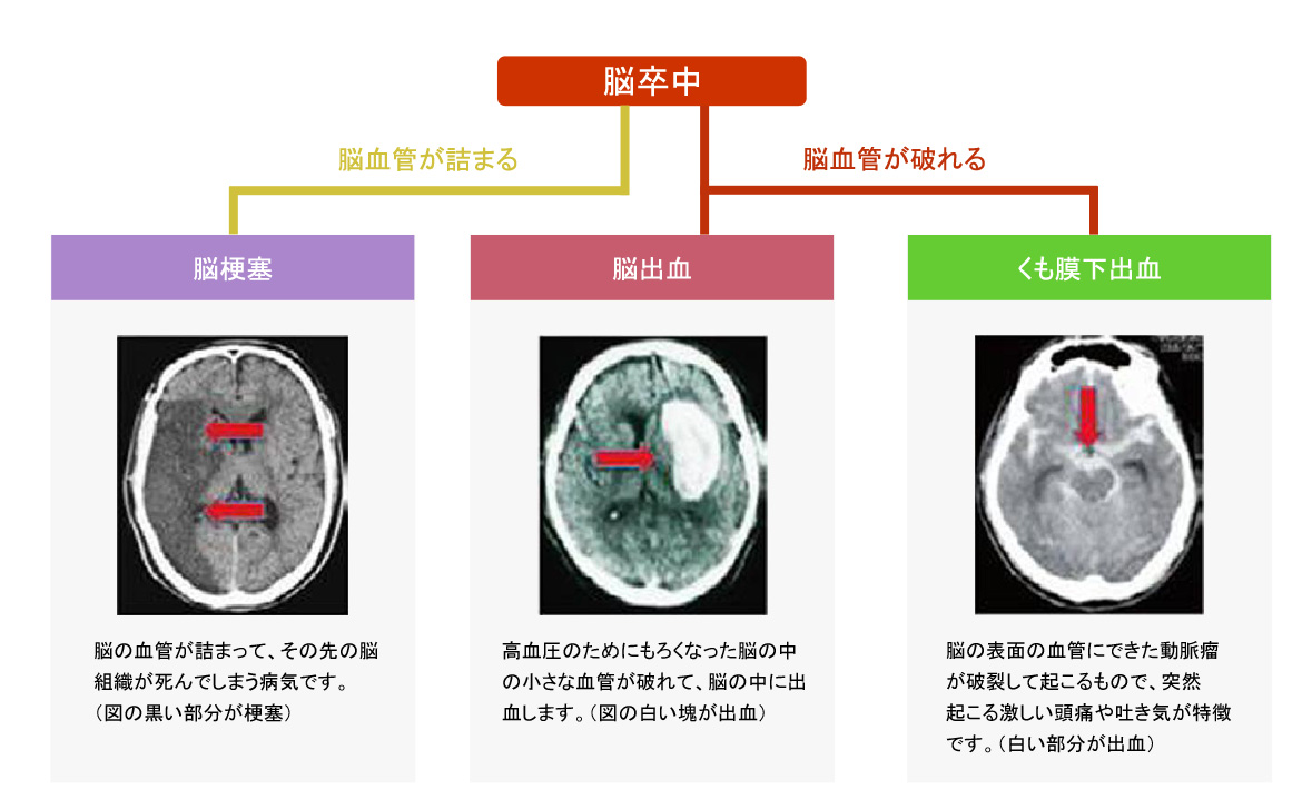 脳卒中の主な３つの種類